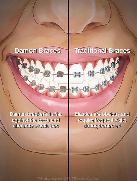 damon metal brackets|damon braces pros and cons.